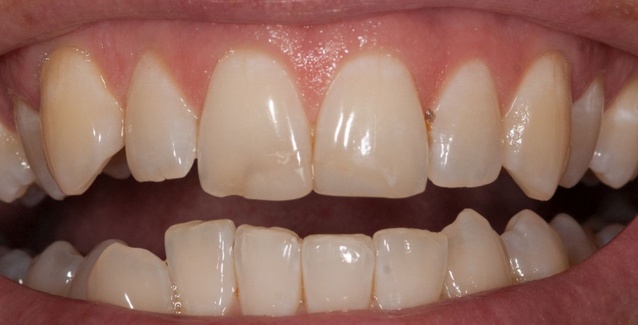 Dental Implants Marietta, GA - Ping Hai DDS - Replace Missing Teeth