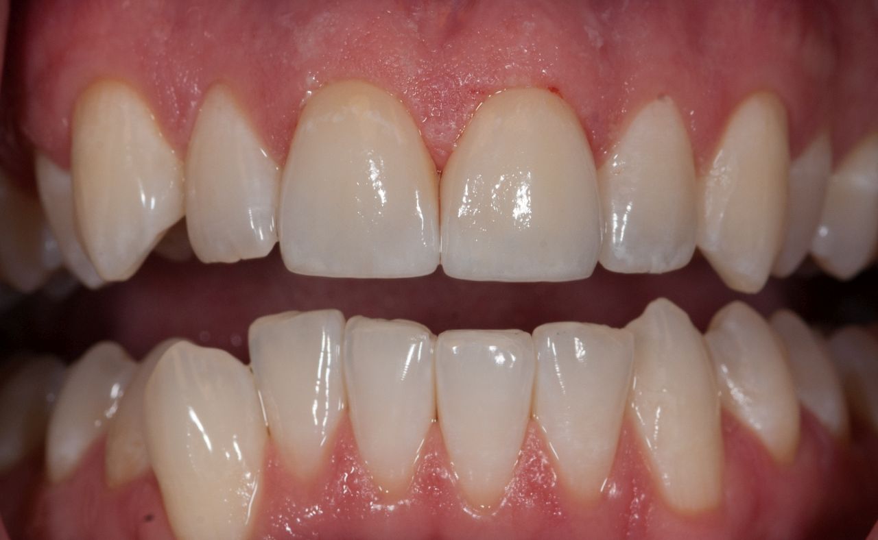 Crowns vs Veneers: Whats the Difference? - Lane & Associates