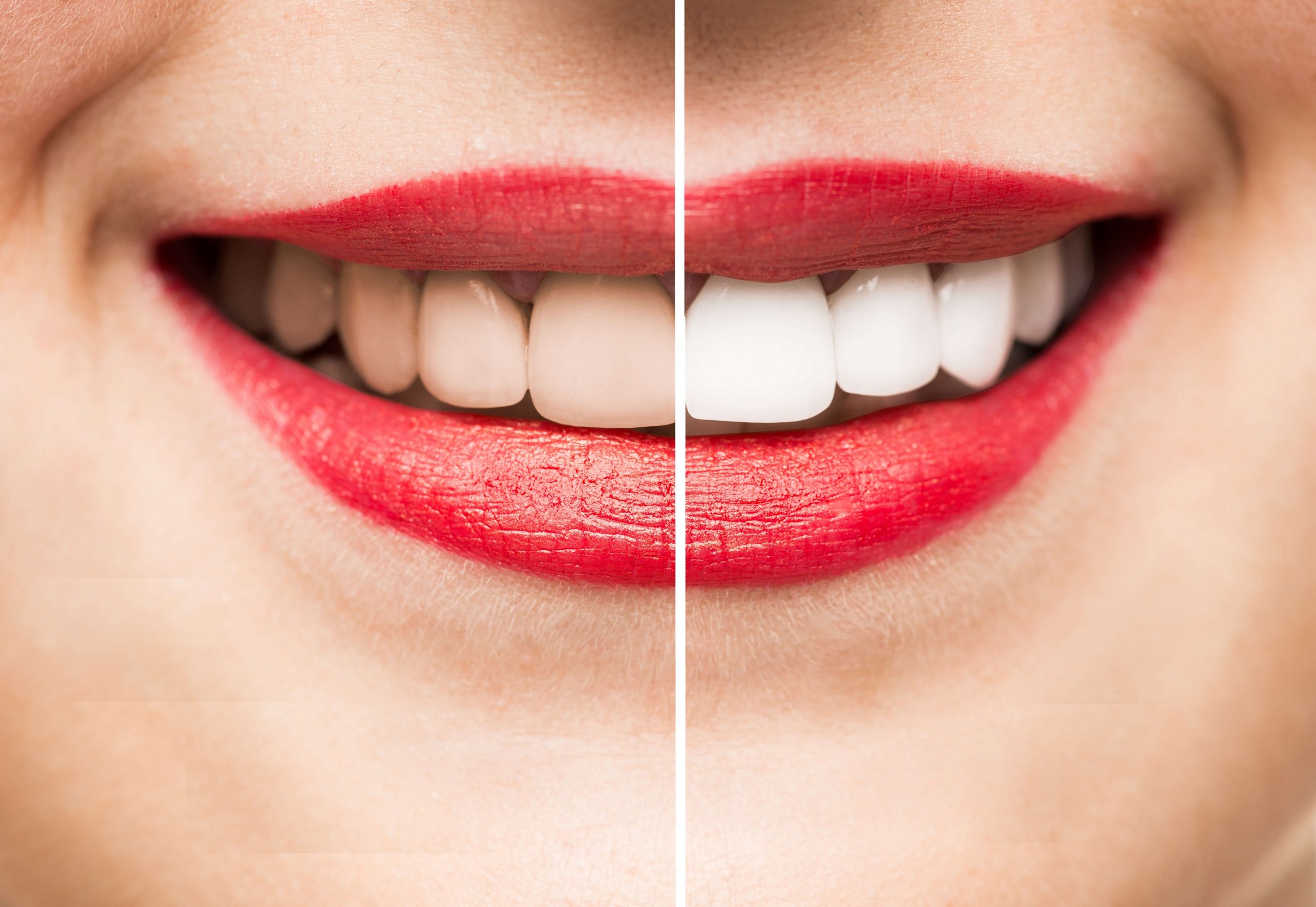 professional-teeth-whitening-from-your-dentist-marietta-ga