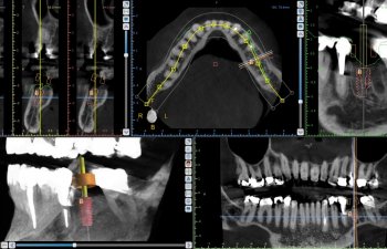 3D guided dental implants imagins
