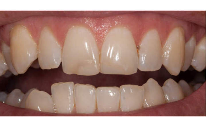 teeth before porcelain veneers procedure