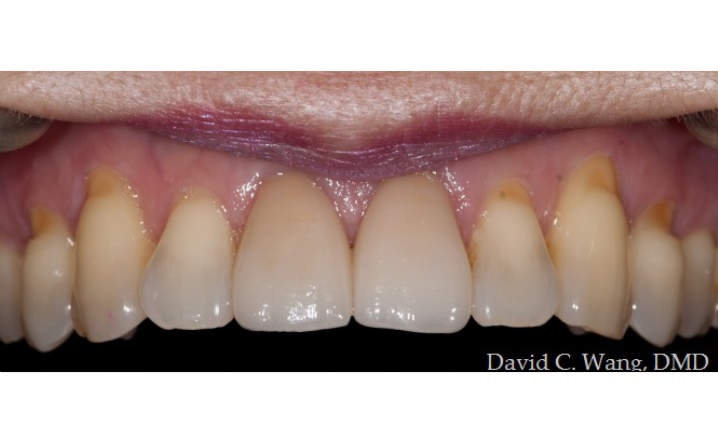 teeth after porcelain veneers procedure