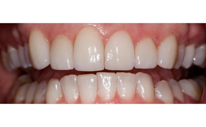 teeth after porcelain veneers procedure