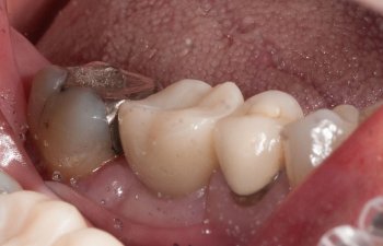 3D guided dental implants