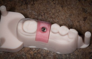 3D guided dental implant model