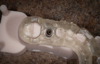 3D guided dental implant