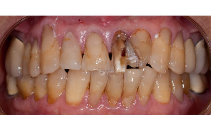teeth before porcelain crowns and veneers procedure