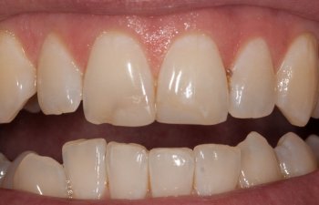 teeth before porcelain veneers procedure
