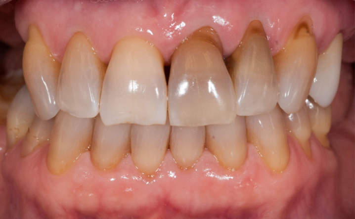 teeth before Kor Whitening
