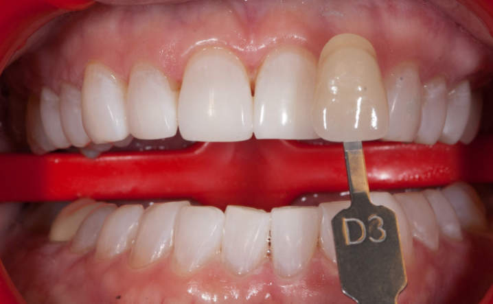 teeth after Kor Whitening