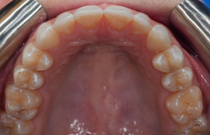 Teeth after space closure with aligners