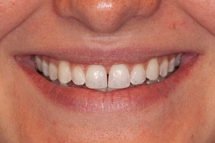 Teeth before space closure with aligners